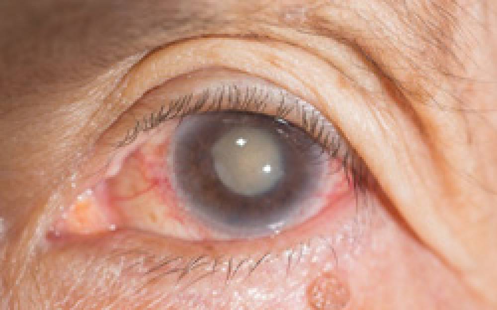 Cataract Surgery